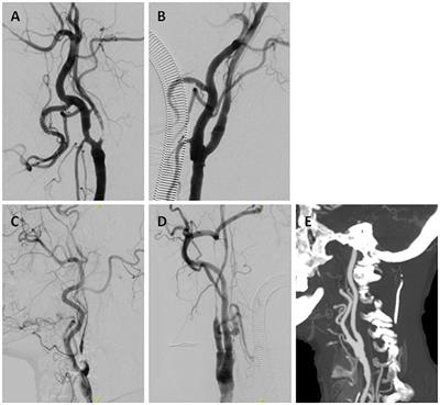 Imaging Identification and Prognosis of the Distal Internal Carotid Artery With Near and Complete Occlusion After Recanalization